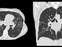 一例COVID-19 (SARS-CoV-2)阳性患者肺部计算机断层扫描(CT)扫描。它显示了典型的白色磨砂玻璃阴影(GGO)，由COVID - 19肺炎引起。肺炎通常沿肺叶壁出现，特别是胸壁和肺的下部。该扫描来自佳能Aquilion Prime SP CT扫描仪，使用人工智能驱动的图像重建软件Advanced intelligent Clear-IQ Engine (ais)来提高图像质量