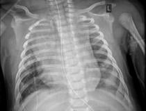 新冠肺炎导致心力衰竭的小儿患者胸部x光片。确诊为COVID-19的2个月大婴儿的胸部x光片显示心脏增大，肺下半部分塌陷导致双颅底混浊，以及右上叶肺不张(肺塌陷)。
