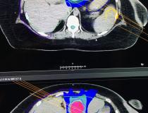 这是Raysearch在今天的ASTRO 2019会议上展示的机器学习和人类创建的胰腺癌放射治疗方案的比较。该供应商获得了FDA对这种机器学习技术和MRI和CT自动分割的批准。# astro19 # astro2019 # astro