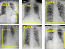 胸部x光检查结果为Covid-19。图片由IEEE提供
