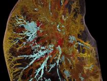 来自伦敦大学学院和欧洲同步加速器研究设施(ESRF)的科学家使用了一种名为分层相位对比断层扫描(HiP-CT)的全新革命性成像技术，扫描捐赠的人体器官，包括新冠肺炎捐赠者的肺。