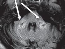 covid -19相关弥散性白质脑病(CRDL)是冠状病毒神经表现患者的一种重要但不常见的差异考虑。轴向FLAIR图像显示双侧小脑中梗T2延长(箭头)。结果与扩散受限和T1低信号区相关，无增强或异常易感性。图片由美国伦琴射线学会(ARRS)、美国伦琴学杂志(AJR)提供。