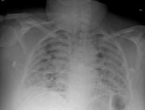 COVID-19重症患者的胸部x光片显示(白色斑块)感染组织扩散到整个肺部。图片由自然出版或npj数字医学提供