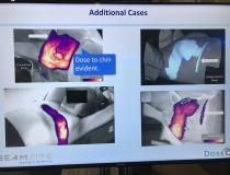 DoseOptic在2020年获得了FDA的许可，其切伦科夫辐射成像系统可用于放射治疗过程中，因此可以可视化辐照场。该系统可以显示出光束不对准的区域，或健康组织不必要的照射。他们在2021年ASTRO上展示了全乳腺放射治疗的例子，光束的边缘击中了患者的下巴和手臂。一段视频展示了病人如何移动，他们把手臂放在治疗区域。# ASTRO #放射治疗