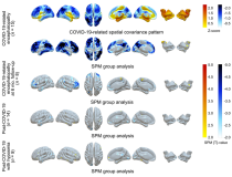 F-18 FDG PET在covid -19相关中枢神经系统疾病中的应用:与健康对照(n=13)相比，covid -19相关脑病患者、covid -19后综合征患者和covid -19后综合征和脑功能减退患者的空间协方差模式主成分分析(第一行)和代谢组差异的统计参数映射分析(第二至第五行)。图片由PT Meyer, S Hellwig, G Blazhenets和JA Hosp制作，德国弗莱堡大学医学中心。