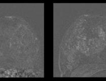 左图为41岁未节育器患者的乳腺MRI。右图显示同一患者放置节育器27个月后实质增强。图片由RSNA提供