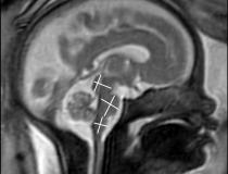 这张图像显示的是胎儿大脑发育的核磁共振成像。图片由RSNA提供
