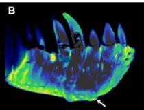左牙含牙部分的CT重建。(A)侧位重建常规CT图像，显示保存完好的解剖结构，如置换牙齿。图片由RSNA提供