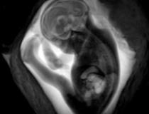 根据今天在北美放射学会(RSNA)年会上提交的一项研究，孕妇中轻度至中度严重的COVID-19似乎对发育中的胎儿的大脑没有影响。