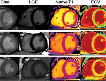 LGE图像、原生T1图、细胞外体积图和全局纵向应变(GLS)显示中、重度COVID-19恢复期成人心肌异常。图片由RSNA提供