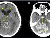 CT显示一名68岁男性COVID-19感染患者出血。图片由RSNA提供