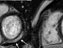 MRI显示左心室基底下外侧和下段明显LGE累及50%以上的心肌。图片由RSNA提供