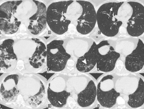 3名既往患有COVID-19肺炎的研究参与者的连续无对比胸部轴向ct。