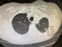 在2021年ASTRO上，飞利浦肿瘤导航软件演示了肺癌结节的测量方法。
