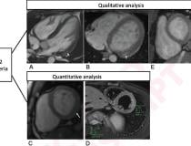 近期接种COVID-19 mRNA引起的心肌炎的基于心肌MRI t2的定性和定量标准定性标准为局灶性心肌水肿，16岁男性(A)和17岁男性(B)在4腔室预对比SSFP图像(箭头)上显示。定量标准包括T2参数映射和心肌信号强度比定量。T2源图像显示左心室基底下壁(箭头)局灶性心外膜下水肿