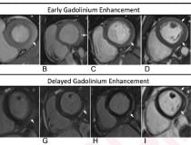 基于心脏MRI t1的近期COVID-19 mRNA烧蚀患者心肌炎标准在(A) 16岁男性，(B) 17岁男性，(C) 16岁男性，(D) 19岁男性的早期造影后短轴SSFP图像上观察到早期钆增强(EGE)与造影前SSFP序列(未显示)相比，在(E) 17岁男性的早期造影后短轴灌注图像上(箭头，A-E)。所有5例患者(F, G, c)均出现晚期钆增强(LGE)(箭头)。