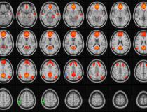 大脑的核磁共振图像。由RSNA