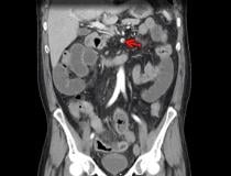 肠系膜上动脉血栓形成(红色箭头)合并肠缺血和穿孔，患者54岁，因腹痛就诊于急诊室，被诊断为COVID-19。腹部和骨盆CT增强图像显示小肠粘膜强化。
