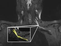 一个20岁出头的病人的磁共振图像显示颈部左臂丛神经损伤(黄色突出)。患者在从COVID-19呼吸道疾病恢复后出现左臂无力和疼痛，这促使他们去看初级保健医生。根据核磁共振检查结果，患者被转到COVID-19神经病学诊所进行治疗。图片由西北大学提供#COVID19 # covid# SARSCoV2