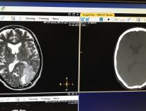 ASTRO 2021年展会上的一个大趋势是引入软件，现在可以将MRI数据集转换为合成CT图像数据集，用于治疗计划过程。这样就不需要CT扫描，可以加快护理速度，降低成本。飞利浦医疗保健公司在左边展示了原始的大脑MRI图像，在右边展示了合成的CT图像。