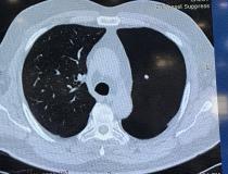 Riverain肺动脉血管抑制人工智能在CT中的应用实例。它可以自动删除肺血管系统只显示肺结节人工智能已经确定不是血管的横断面视图。