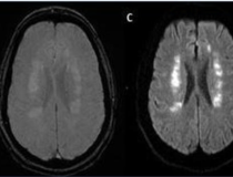 急性大脑前动脉/大脑中动脉分水岭梗死，47岁男性，表现为COVID-19肺炎。图片由RSNA提供