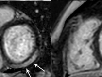 MRI显示青春期女性左心室基底下段和下段及中心室水平左心室前段、下段和下段的明显LGE累及50%以上的心肌。注意:此图片仅用于说明目的，与十大研究组无关。影像由放射科提供:心胸影像学。