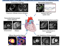 疑似COVID-19急性心肌炎的心脏MRI表现示例。注意:此图片仅用于说明目的，与十大研究组无关。影像由放射科提供:心胸影像学。