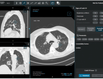 在STOIC的研究中，读者将CT检查分为COVID阳性、COVID阴性和正常。读者可以使用3d图像可视化web应用程序访问CT扫描结果，允许在冠状面、矢状面或轴向横断面上滚动整个肺容积。由于双侧磨玻璃影存在，且无粘液样嵌塞、细支气管结节、节段或大叶实变等特征，CT扫描被划分为COVID阳性。图像c