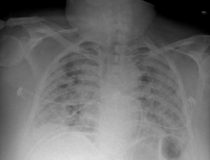 COVID-19重症患者的胸部x光片显示(白色斑块)感染组织扩散到整个肺部。图片由自然出版或npj数字医学提供