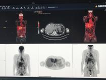 核显像PET-CT显示一例肝癌多发转移。作为Sectra企业成像系统演示的一部分。