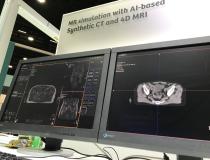一个从MRI数据集创建的合成CT扫描数据集的例子，用于放射治疗计划，因此不需要额外的CT扫描。这个例子来自2021年美国放射肿瘤学会(ASTRO)会议上的西门子Healthineers。左边的图像是MRI图像，右边的图像是由MRI数据集创建的合成CT。一些供应商正在展示这项技术，允许使用MRI软组织成像来创建ct，以避免额外的扫描。