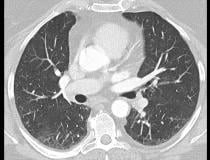 新冠肺炎后患者使用西门子Naeotom Alpha光子计数CT系统的肺部图像。光子计数技术可以同时获取和可视化细节结构(中心图像)结合功能信息(右图像)。左图为常规CT图像对比图。捷克共和国Plzen大学医院J. Ferda医生提供。<a href=