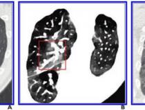 A，常规轴向CT初始图像显示右上肺叶未见明显肺损伤(红框内)。B，与A图像同时获得的CT电子密度谱图像显示右上叶病变(红框内)。C，在A、B片确认右上叶病变(红框内)后5天，随访常规轴向胸部CT图像。图片由美国伦琴射线学会(ARRS)、美国伦琴学杂志(AJR)提供