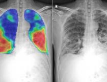 许多供应商已经开发了人工智能(AI)算法，通过CT或DR成像自动检测和评分肺部COVID-19肺炎的严重程度。胸片显示的是由Thirona和Delft Imaging公司开发的CAD4COVID AI软件。它将生成一个0到100分之间的分数，表明与COVID-19相关的异常程度，通过热图显示这种肺部异常，并量化肺部受影响的百分比。肺部的冠状病毒区表现为