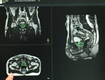 这是在ASTRO 2019上用Elekta Unity MRI引导的RT系统演示的肝脏肿瘤放射治疗束传输的实时MRI成像示例。它展示了实时成像如何显示呼吸引起的器官/肿瘤运动。目前，如果肿瘤移动超出耐受范围，放射治疗师可以关闭光束，但该公司正致力于自动关闭/打开光束功能，以考虑运动。