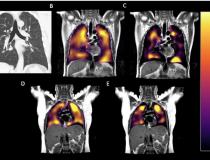 60岁男子长时间感染covid。covid后呼吸困难史，显示出院后172天。(A) CT， (B)氙129 MRI通气显像，(C) RBC相位显像。(D)健康对照的Xe-129 MRI气体成像和(E) RBC相位成像。x -129 MRI图像显示冠状位，由于微栓子，患者红细胞被破坏。图片由RSNA提供。