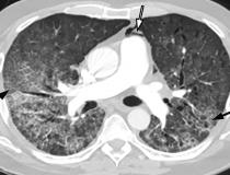 一名61岁男子并发COVID-19纵隔气肿。轴向胸部CT血管造影图像显示典型的COVID-19肺炎表现，包括弥漫性GGOs和小叶间隔增厚(黑色箭头)。空气位于肺动脉前方(白色箭头)，与肺动脉主动脉和左心耳相邻，提示纵隔气肿。图片由Margarita Revzin等人提供。COVID在肺