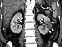 一例由COVID-19引起的凝血引起的肾梗死器官损伤，患者为57岁，表现为腹痛。图片由Margarita Rezvin等人提供。阅读更多有关试验的内容 examining the use of anticoagulation to treat COVID clotting.
