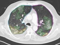 人工智能算法自动识别肺部的COVID-19肺炎区域，并在无需人工干预的情况下对病变进行量化，以帮助加快工作流程。包括西门子和飞利浦在内的几家供应商在2020年开发了针对COVID-19的AI算法。这是飞利浦的CT Pulmo自动结果CT。该软件进行自动肺分割和病变分割，并对磨砂玻璃混浊/实变进行分类。它自动生成的报告包括卷。