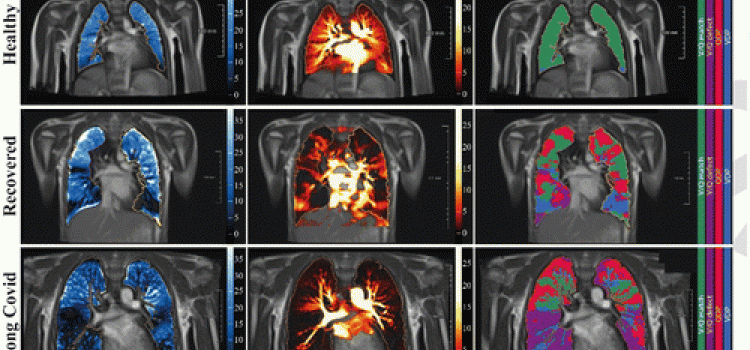 自由呼吸相位分辨功能肺(PREFUL)低场MRI 0.55T，轴向面计算参数，自动配准到呼气中位置，肺实质分割。从左到右，具有代表性的功能彩色编码图像显示健康对照组(上一排，7岁男性)的通气缺陷(VDP，蓝色)、灌注缺陷(QDP，红色)、通气/灌注(V/Q匹配，绿色)、通气/灌注缺陷(V/Q缺陷，紫色)