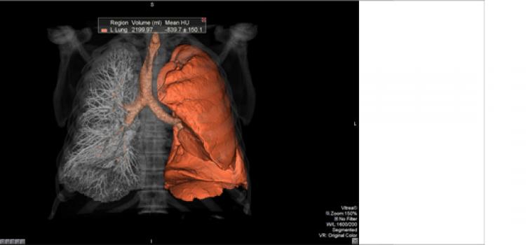 ASTRO医疗保险低剂量CT筛查成人肺癌CT系统