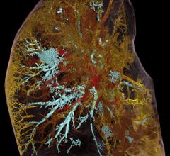 来自伦敦大学学院和欧洲同步加速器研究机构(ESRF)的科学家们使用了一种名为分层相位对比断层扫描(HiP-CT)的革命性新成像技术，扫描捐赠的人体器官，包括Covid-19捐赠者的肺。