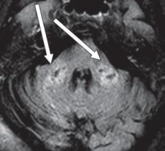 FLAIR MR轴向图像显示双侧小脑中梗T2延长(箭头)。结果与扩散受限和T1低强度信号区域相关，无增强或异常敏感性。图片由美国伦琴射线学会(ARRS)、美国伦琴学杂志(AJR)提供