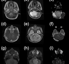 儿童脑瘤患者的MR图像。第一列显示注射钆造影剂后的t1加权图像。第二列显示t2加权图像，最后一列显示从扩散加权图像计算的表观扩散系数图。(a - c)取自一名毛细胞星形细胞瘤患者，(d-f)取自一名室管膜瘤患者，(g-i)取自一名髓母细胞瘤患者。