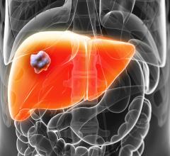 这项研究合作协议涵盖了一项关于非酒精性脂肪性肝炎(NASH)患者肝纤维化严重程度的联合临床回顾性研究