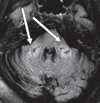 FLAIR MR轴向图像显示双侧小脑中梗T2延长(箭头)。结果与扩散受限和T1低强度信号区域相关，无增强或异常敏感性。图片由美国伦琴射线学会(ARRS)、美国伦琴学杂志(AJR)提供