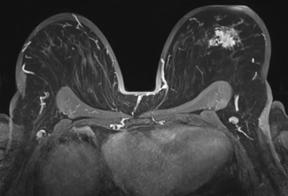乳房MRI示左乳肿瘤灶，轴位。