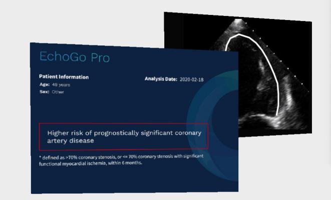 EchoGo Pro自动化心脏超声测量心脏功能,但也让医生预测冠状动脉疾病(CAD)的发生。
