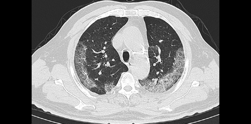 胸部CT成像的病人。#冠状病毒# nCoV2019 # 2019 ncov # COVID19